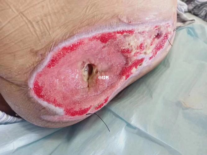 别在躺着了,起来走走吧,褥疮修复