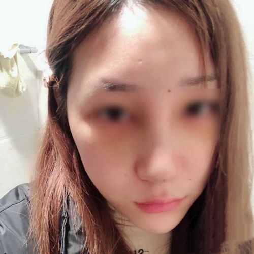 这是我前段时间去打了玻尿酸垫山根的样子,打完后没多久,山根变得又宽