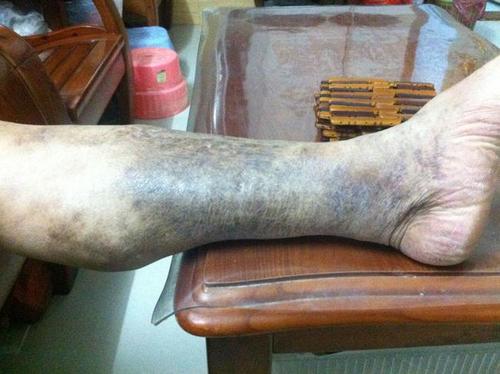 最常见原因就是脉管炎,如果判断错误可能会失去最好的检查和治疗时机