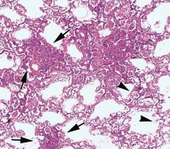 刘敏:病毒性肺炎的ct影像学特征分析