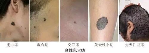 痣(nevue)在医学上称作痣细胞或黑素细胞痣,是表皮,真皮内黑素细胞