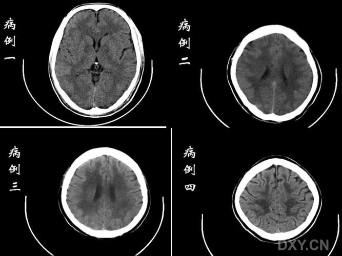 脑白质病变_new_new解析.docx