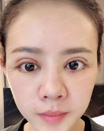 关于提肌: 其实双眼大小眼的问题,就是左右眼力量不均衡而导致的,眼睛