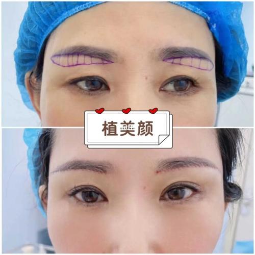 切眉_提眉切眉_美妆_医美整形