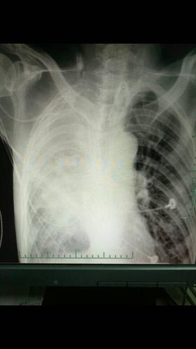 呼吸衰竭入住我院icu,今日出现呼吸急促,费力,听诊右肺呼吸音低,拍