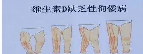 小儿鸡胸是佝偻病吗?维生素d缺乏会引起小儿鸡胸吗?对