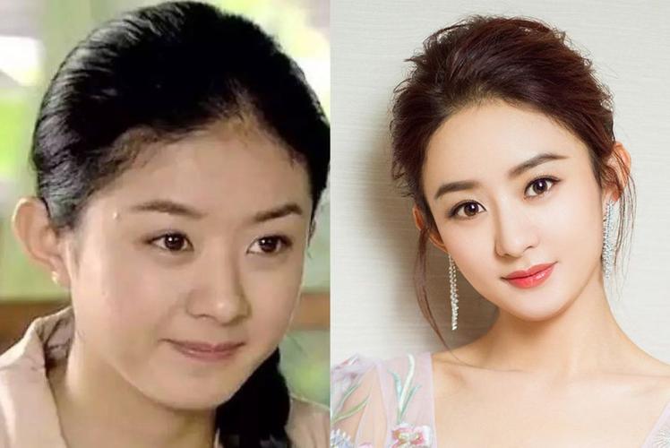 宋慧乔以前的发际线形状比较不规则,而且绒毛很多,经过调整,发际线