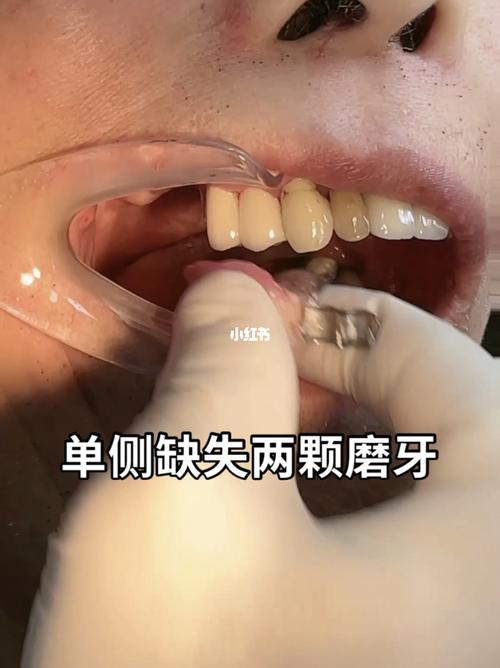 精密附件义齿优缺点_美妆_医美整形