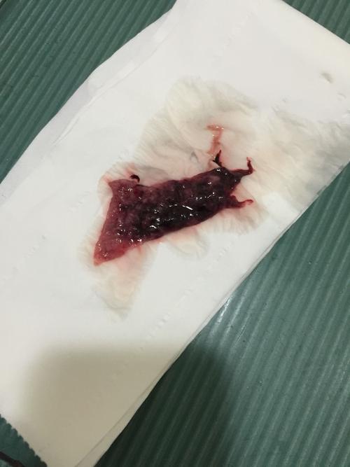 [试管婴儿]有图慎点,刚刚排出来的是孕囊吗?排出来之前肚子坠着疼