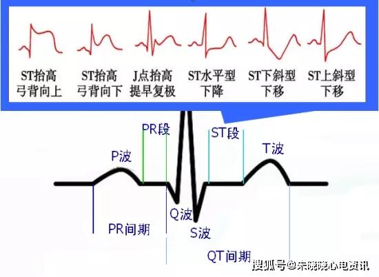 范围和程度的不同,分为五种临床类型:一,无症状型冠心病;二,心绞痛型