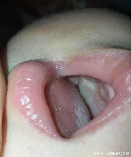 新生婴儿长出了"马牙",随便处理会危及生命!家长注意了