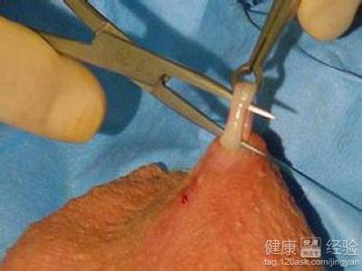 其实真正要来说男方结扎比女方要方便得多,至少是挺简单的一项手术