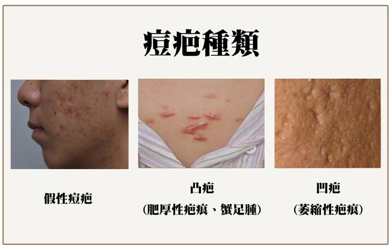 假性痘疤,凸疤,凹疤,痘疤的种类形态分类,植发,医美,专业医美,高雄