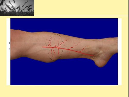 胫后动脉穿支皮瓣