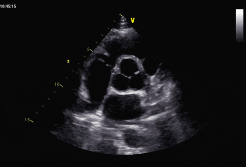 5 平方厘米  室间隔明显增厚者,二尖瓣可出现sam征,心尖区可闻及收缩