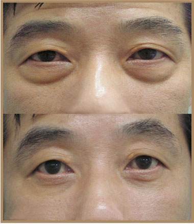 【去眼袋手术】本人黑眼圈声明有黑眼圈只是因为它