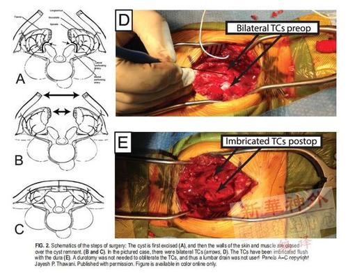 骶管囊肿文献导读:显微外科治疗骶管囊肿:病例讨论和