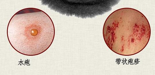 带状疱疹的日常护理