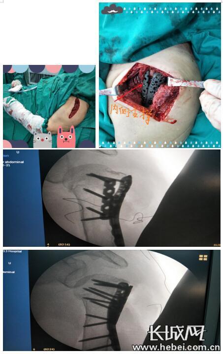 石家庄市三院成功治疗高龄老年肱骨近端粉碎骨折