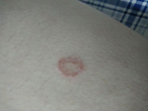 大腿上有一小块皮肤摸上去像蜕皮了一样,痒,有个红圈