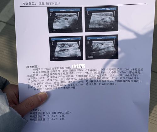 乳腺多发性结节