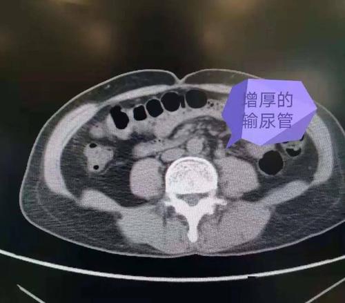 案例故事 | 嵌顿结石堵死输尿管"腰痛积水",顺行软镜钬激光发威"水落