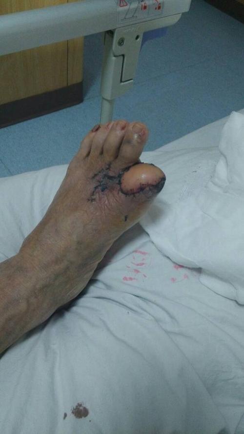 交通事故导致左脚大脚趾几乎全部切除 能评上十级了吗?