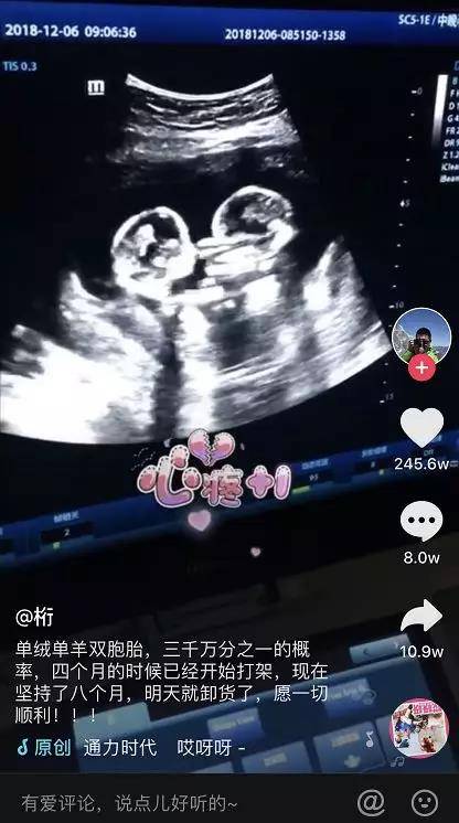 这段双胞胎在妈妈肚子里打架的视频,火了!