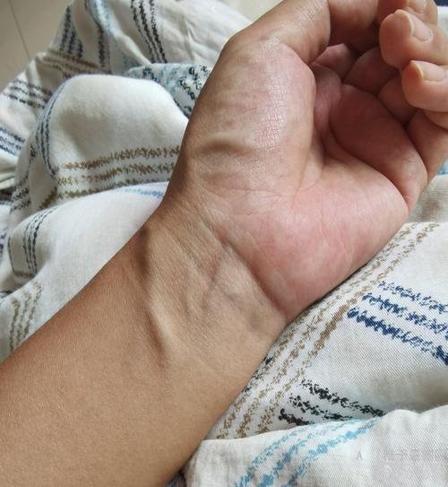 你们孕晚期有没有像我一样手腕血管又凸又