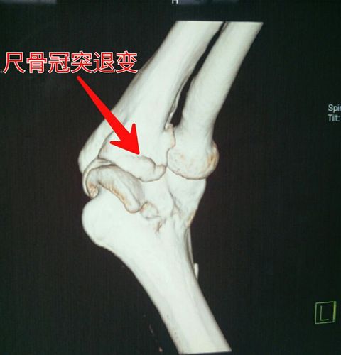 尺骨冠突可见退行性改变,轻度骨赘增生.