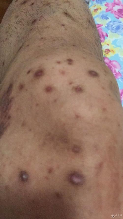 皮肤溃烂一直不好