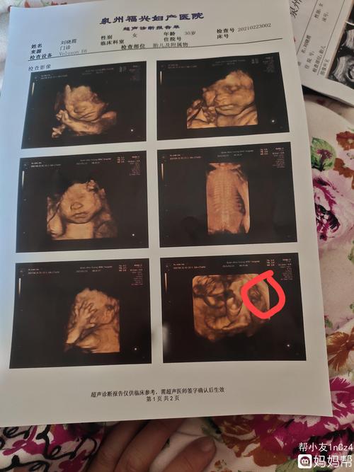 四维彩超,谁会看男女?