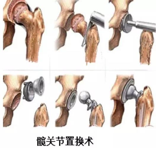 麻醉科等多学科联合会诊,最终选定为患者行左侧人工半髋关节置换术的