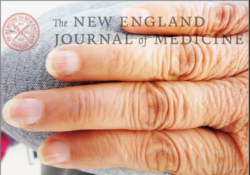 偶然发现指甲颜色半白半红竟是肾脏出了问题