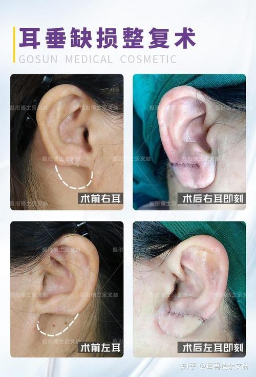 耳垂缺损了可以治疗吗?治疗要多久?