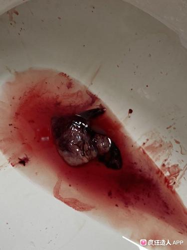 [试管婴儿]胎停后还没到人流时间孕囊自己脱落血腥,慎入!