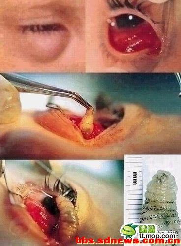 美瞳戴久后眼睛里长出虫子来(可怕啊)