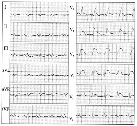 图19-7 完全性右束支传导阻滞伴前壁心肌梗死心电图