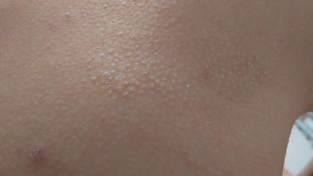 背部皮肤粗糙摸起来像鸡皮疙瘩.