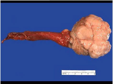 男性,57岁,因左侧睾丸进行性肿大行睾丸切除.大体见呈