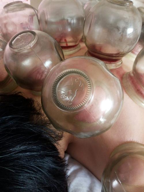 【拔罐】春天易感风邪,拔罐疗效最好!