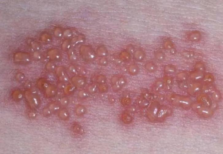 09:41芝罘区疾控中心提醒:1月重点预防流感,水痘等疾病海报烟台·01