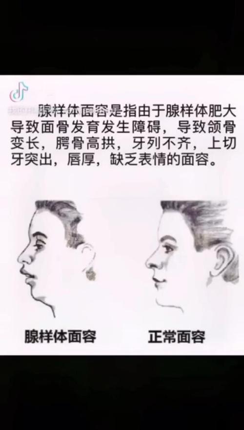 腺样体面容的形成机理与治疗