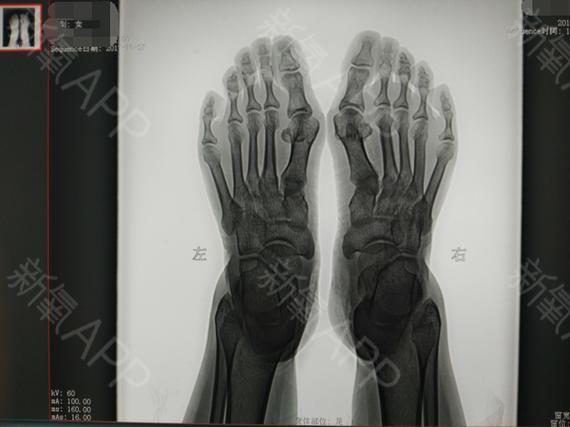 天生的大脚骨,x光片上能够清晰的看到大拇指外翻特别