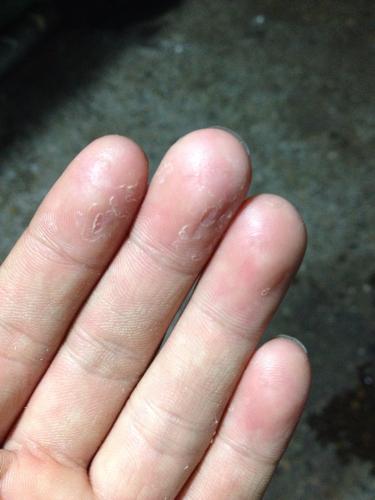 特别烦人手指一直脱皮.一年四季都这样脱