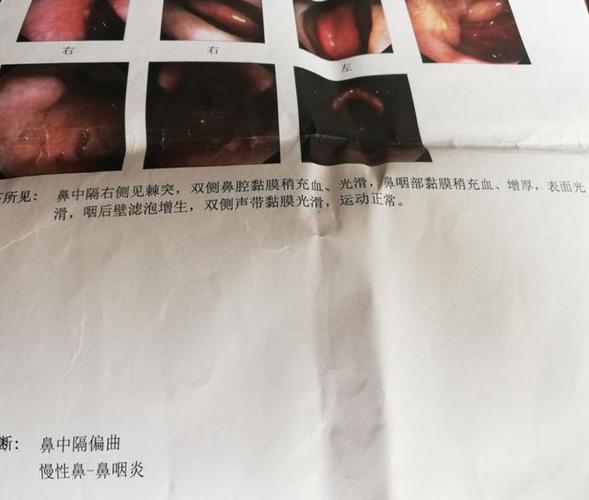 我人生第一次做鼻咽镜检查,吓死了!