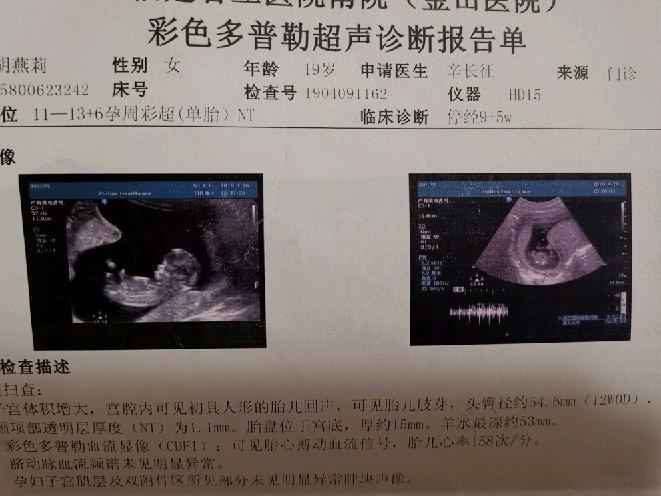 已生女儿ntnt胎心163分是男孩还是女孩