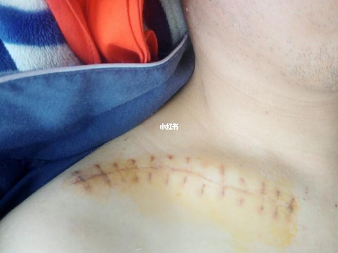 把锁骨挤骨折了!无法保守治疗!只能做手术!