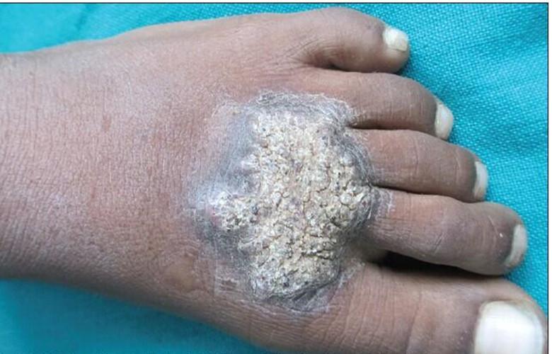 皮肤结核病介绍_皮肤结核病病因_皮肤结核病治疗_皮肤结核病医院医生