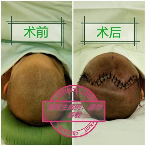 颅缝早闭三角头畸形的手术前后
